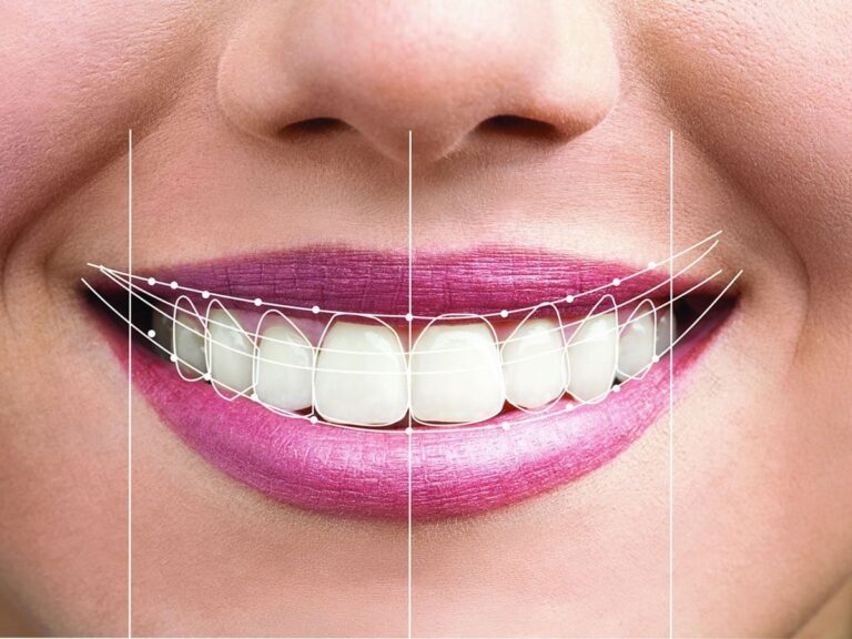 hollywood smile